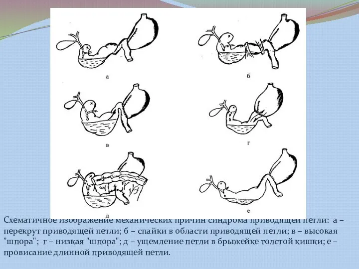 Схематичное изображение механических причин синдрома приводящей петли: а – перекрут приводящей петли;