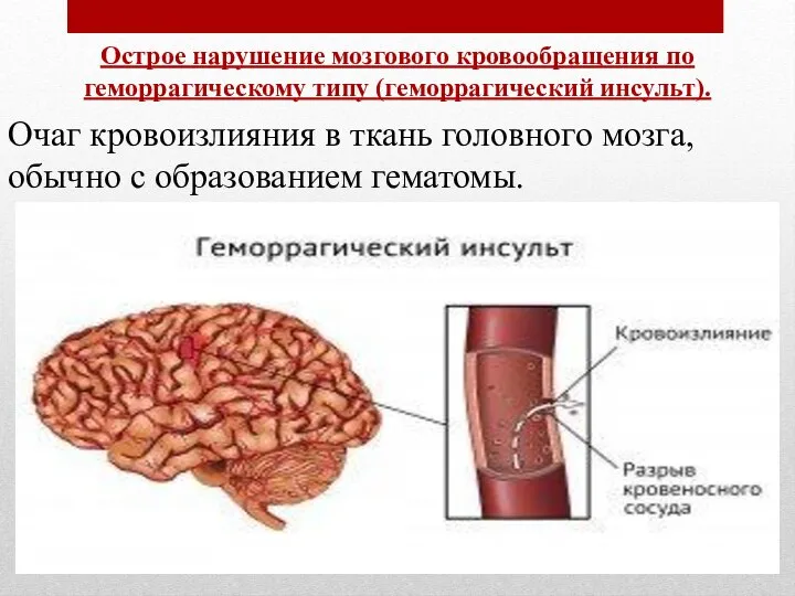 Острое нарушение мозгового кровообращения по геморрагическому типу (геморрагический инсульт). Очаг кровоизлияния в