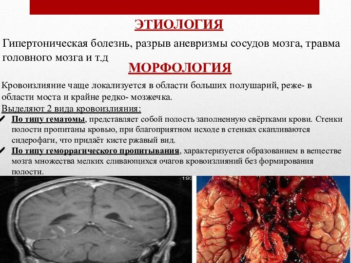 ЭТИОЛОГИЯ Гипертоническая болезнь, разрыв аневризмы сосудов мозга, травма головного мозга и т.д