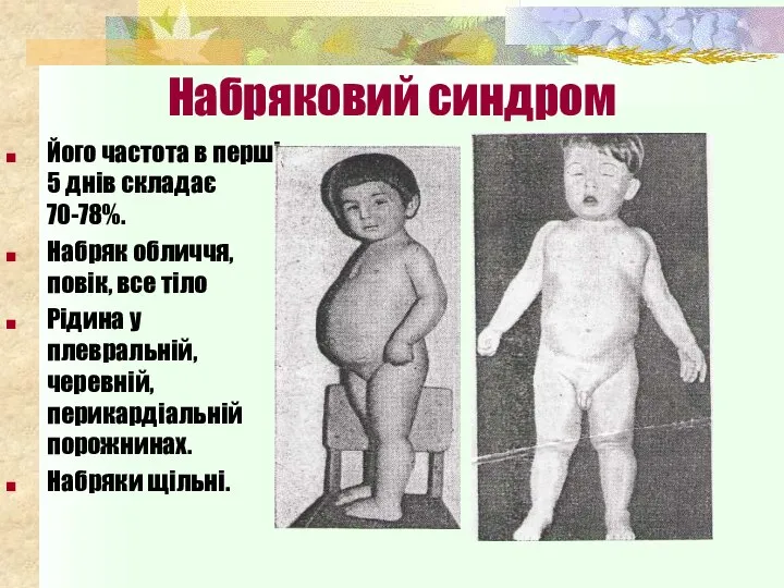 Набряковий синдром Його частота в перші 5 днів складає 70-78%. Набряк обличчя,