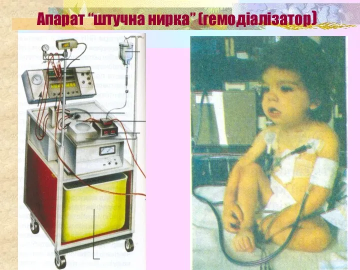 Апарат “штучна нирка” (гемодіалізатор)