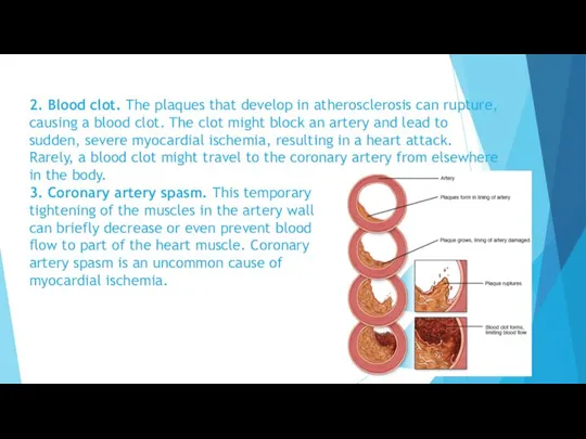 2. Blood clot. The plaques that develop in atherosclerosis can rupture, causing