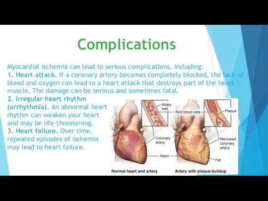 Myocardial ischemia can lead to serious complications, including: 1. Heart attack. If