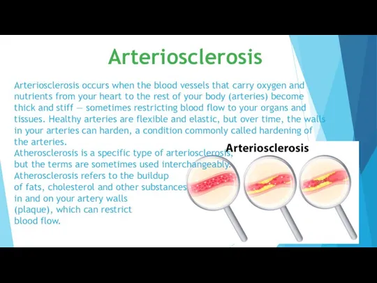 Arteriosclerosis occurs when the blood vessels that carry oxygen and nutrients from