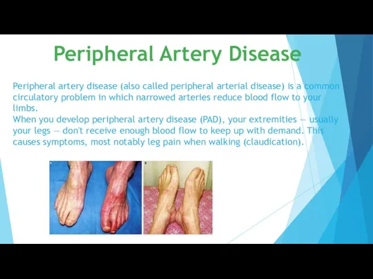 Peripheral artery disease (also called peripheral arterial disease) is a common circulatory
