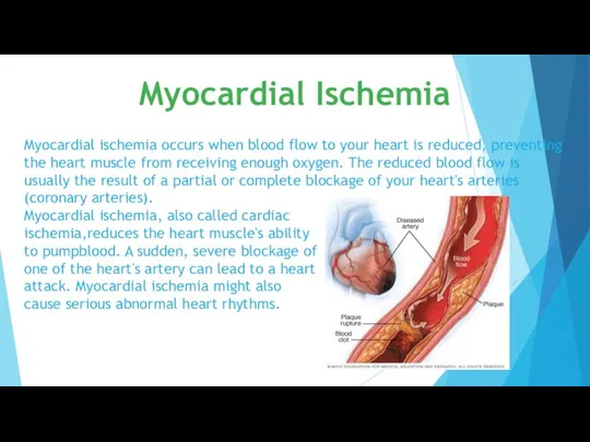 Myocardial ischemia occurs when blood flow to your heart is reduced, preventing