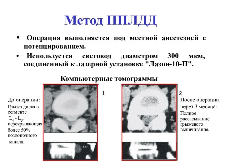 Метод ППЛДД Операция выполняется под местной анестезией с потенцированием. Используется световод диаметром