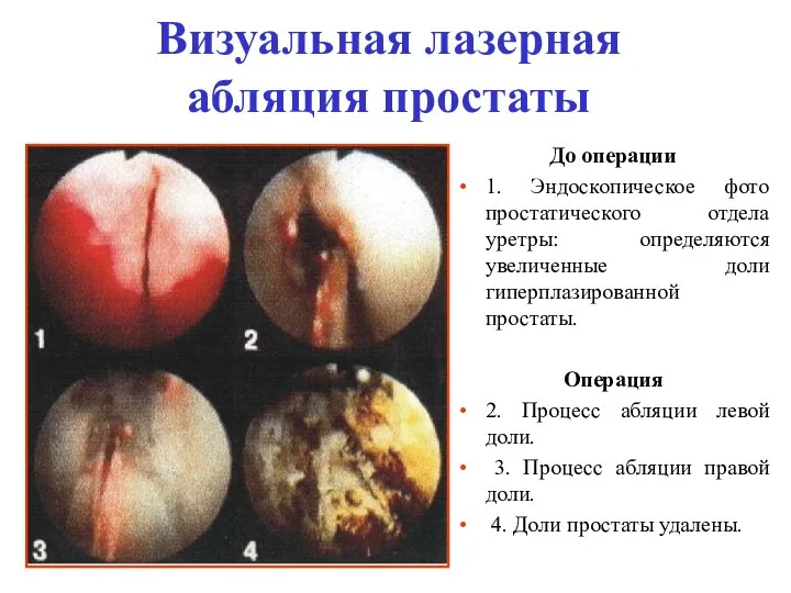 Визуальная лазерная абляция простаты До операции 1. Эндоскопическое фото простатического отдела уретры: