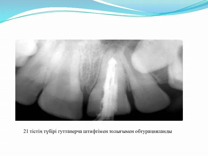 21 тістің түбірі гуттаперча штифтімен толығымен обтурацияланды