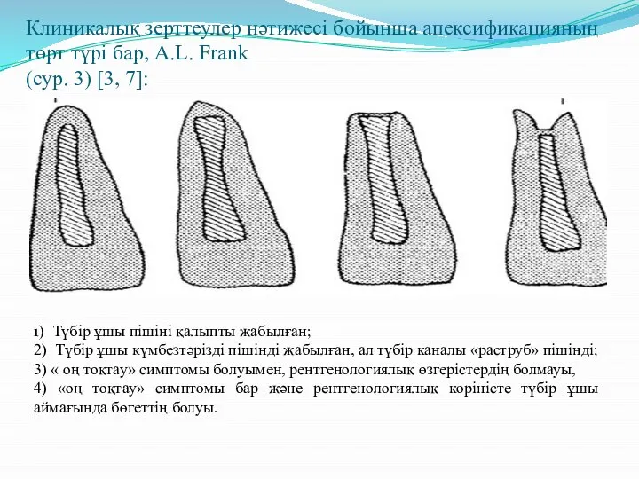 Клиникалық зерттеулер нәтижесі бойынша апексификацияның төрт түрі бар, A.L. Frank (сур. 3)