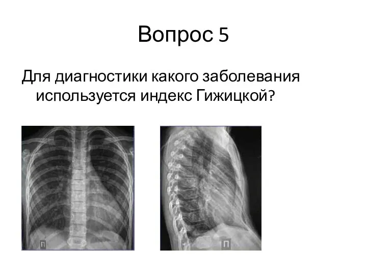 Вопрос 5 Для диагностики какого заболевания используется индекс Гижицкой?