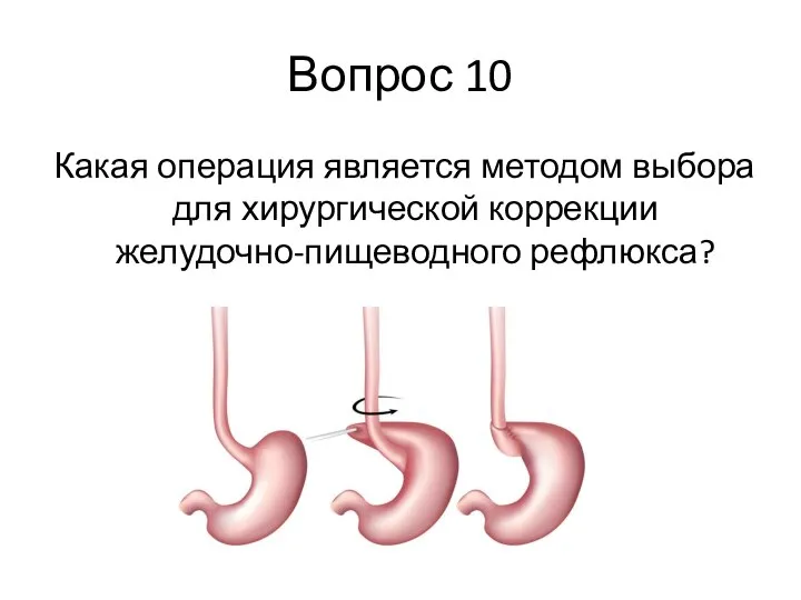 Вопрос 10 Какая операция является методом выбора для хирургической коррекции желудочно-пищеводного рефлюкса?