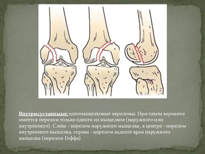 Внутрисуставныые одномыщелковые переломы. При таком варианте имеется перелом только одного из мыщелков