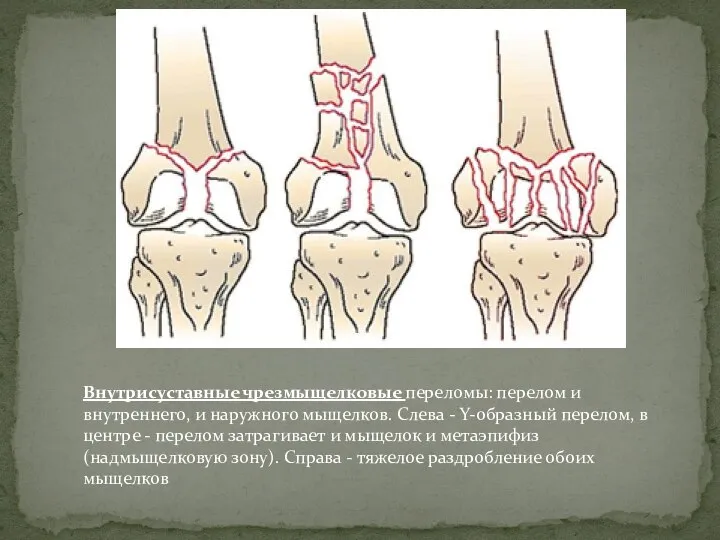 Внутрисуставные чрезмыщелковые переломы: перелом и внутреннего, и наружного мыщелков. Слева - Y-образный