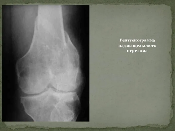 Рентгенограмма надмыщелкового перелома
