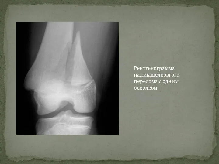 Рентгенограмма надмыщелковгого перелома с одним осколком