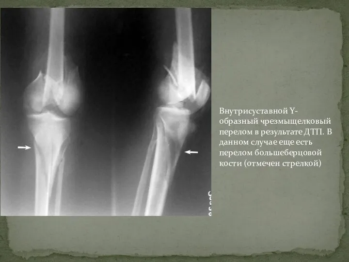 Внутрисуставной Y-образный чрезмыщелковый перелом в результате ДТП. В данном случае еще есть