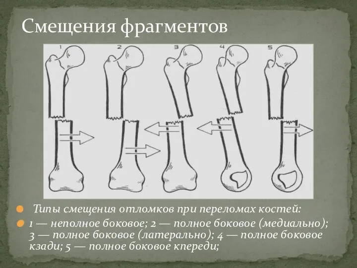 Смещения фрагментов Типы смещения отломков при переломах костей: 1 — неполное боковое;