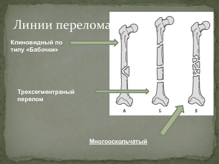 Линии перелома Клиновидный по типу «Бабочки» Трехсегментраный перелом Многооскольчатый