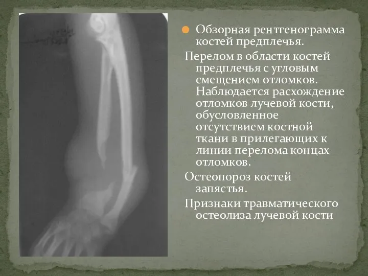 Обзорная рентгенограмма костей предплечья. Перелом в области костей предплечья с угловым смещением