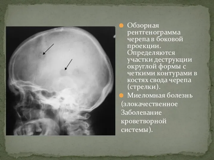 Обзорная рентгенограмма черепа в боковой проекции. Определяются участки деструкции округлой формы с