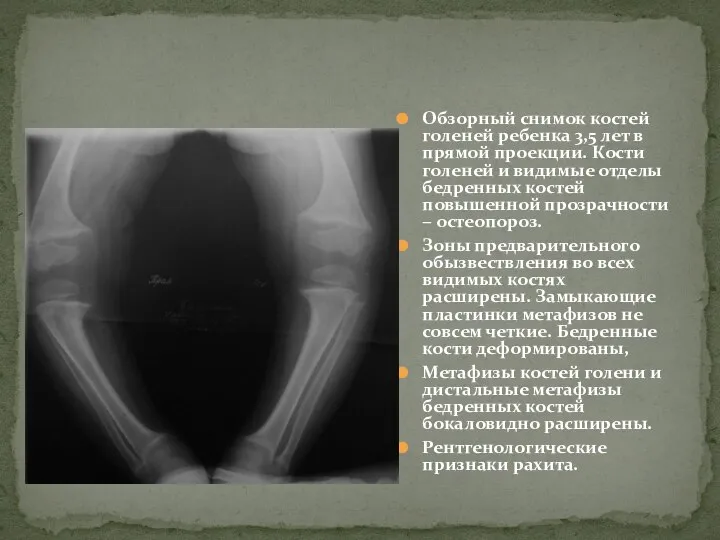 Обзорный снимок костей голеней ребенка 3,5 лет в прямой проекции. Кости голеней