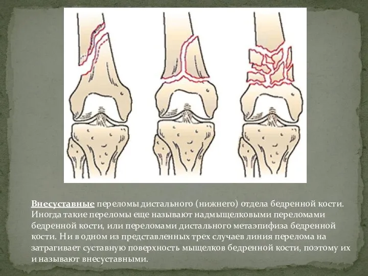 Внесуставные переломы дистального (нижнего) отдела бедренной кости. Иногда такие переломы еще называют