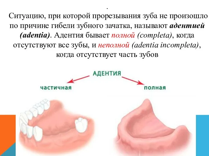 . Ситуацию, при которой прорезывания зуба не произошло по причине гибели зубного