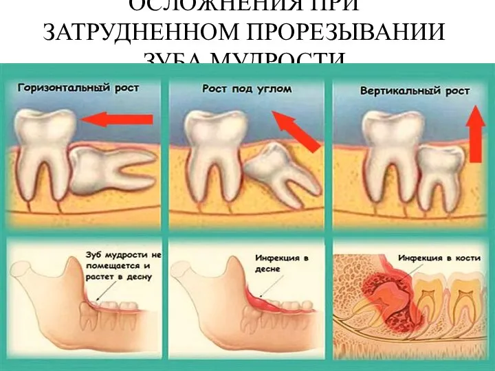 ОСЛОЖНЕНИЯ ПРИ ЗАТРУДНЕННОМ ПРОРЕЗЫВАНИИ ЗУБА МУДРОСТИ