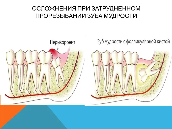 ОСЛОЖНЕНИЯ ПРИ ЗАТРУДНЕННОМ ПРОРЕЗЫВАНИИ ЗУБА МУДРОСТИ Острый перикоронорит Параденталъные кисты