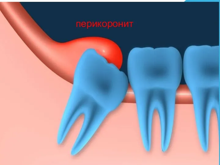 перикоронит