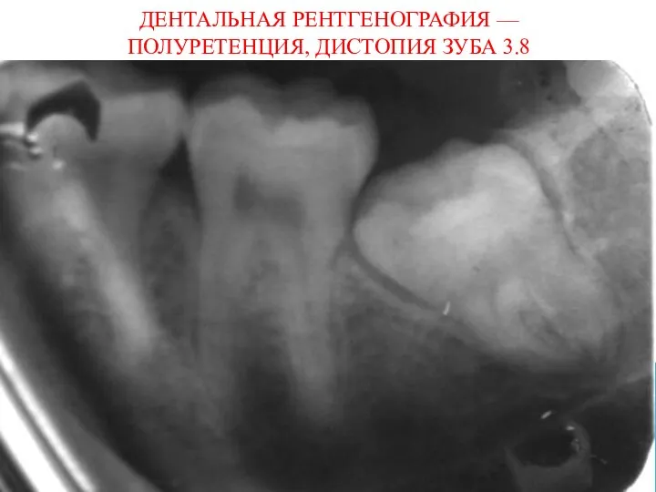 ДЕНТАЛЬНАЯ РЕНТГЕНОГРАФИЯ — ПОЛУРЕТЕНЦИЯ, ДИСТОПИЯ ЗУБА 3.8