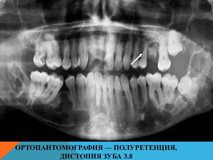 ОРТОПАНТОМОГРАФИЯ — ПОЛУРЕТЕНЦИЯ, ДИСТОПИЯ ЗУБА 3.8