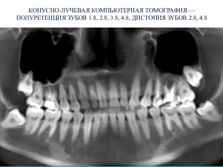 КОНУСНО-ЛУЧЕВАЯ КОМПЬЮТЕРНАЯ ТОМОГРАФИЯ — ПОЛУРЕТЕНЦИЯ ЗУБОВ 1.8, 2.8, 3.8, 4.8, ДИСТОПИЯ ЗУБОВ 2.8, 4.8