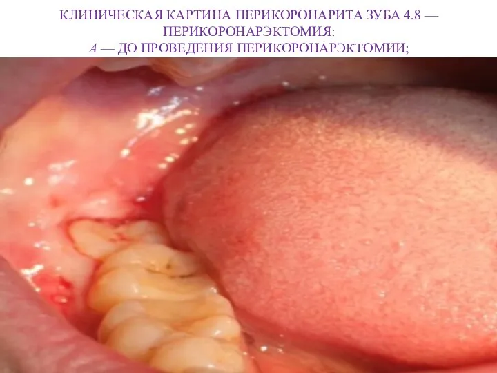 КЛИНИЧЕСКАЯ КАРТИНА ПЕРИКОРОНАРИТА ЗУБА 4.8 — ПЕРИКОРОНАРЭКТОМИЯ: А — ДО ПРОВЕДЕНИЯ ПЕРИКОРОНАРЭКТОМИИ;