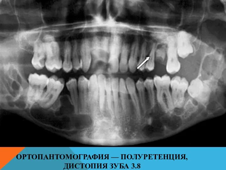 ОРТОПАНТОМОГРАФИЯ — ПОЛУРЕТЕНЦИЯ, ДИСТОПИЯ ЗУБА 3.8