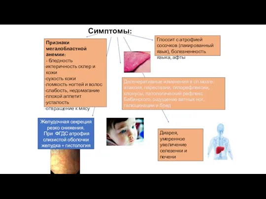 Симптомы: Признаки мегалобластной анемии: - бледность иктеричность склер и кожи сухость кожи