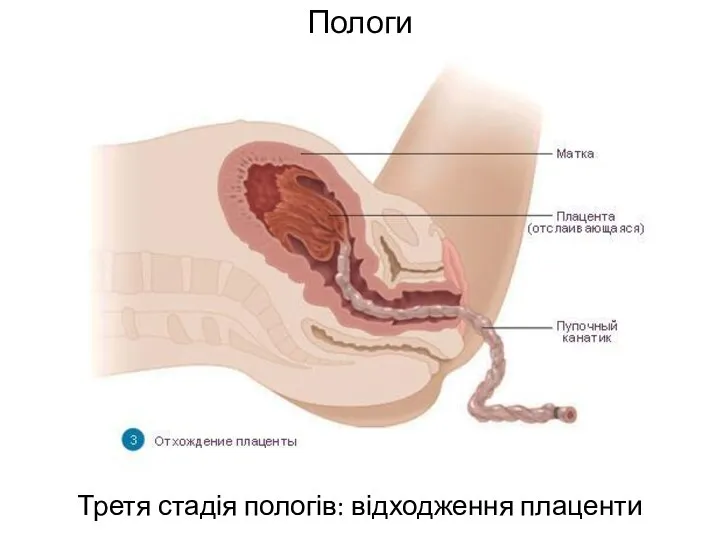 Пологи Третя стадія пологів: відходження плаценти
