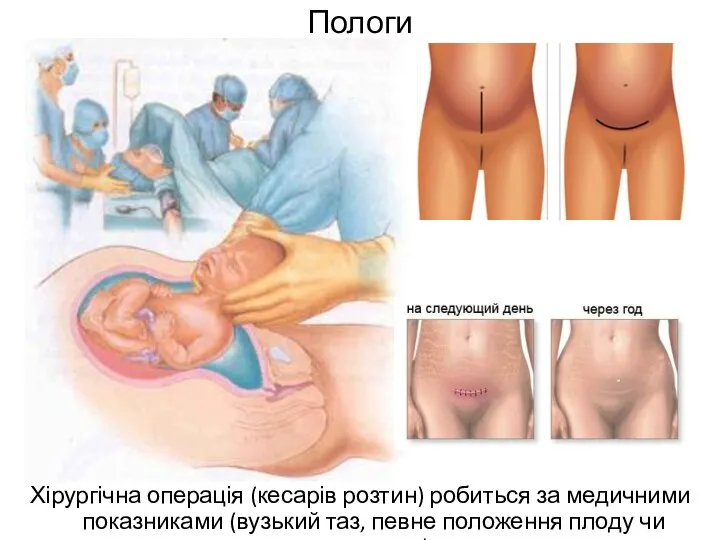 Пологи Хірургічна операція (кесарів розтин) робиться за медичними показниками (вузький таз, певне положення плоду чи плаценти)