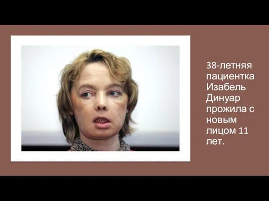 38-летняя пациентка Изабель Динуар прожила с новым лицом 11 лет.