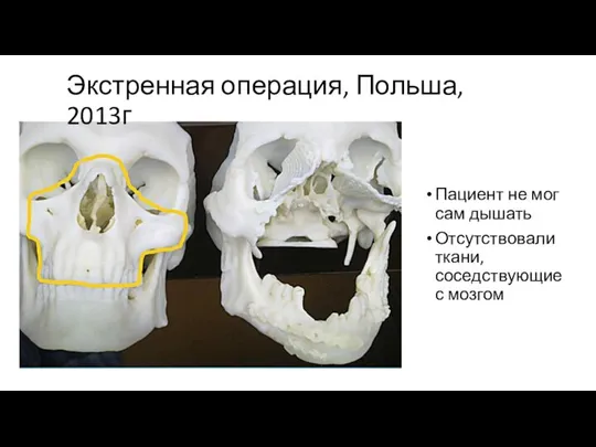 Экстренная операция, Польша, 2013г Пациент не мог сам дышать Отсутствовали ткани, соседствующие с мозгом