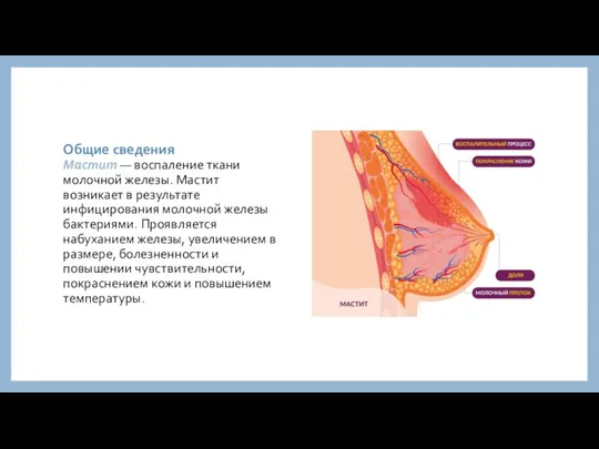 Общие сведения Мастит — воспаление ткани молочной железы. Мастит возникает в результате