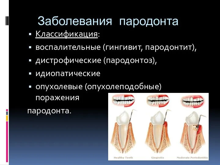 Заболевания пародонта Классификация: воспалительные (гингивит, пародонтит), дистрофические (пародонтоз), идиопатические опухолевые (опухолеподобные) поражения пародонта.