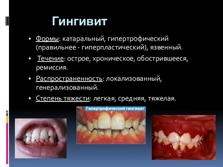 Гингивит Формы: катаральный, гипертрофический (правильнее - гиперпластический), язвенный. Течение: острое, хроническое, обострившееся,