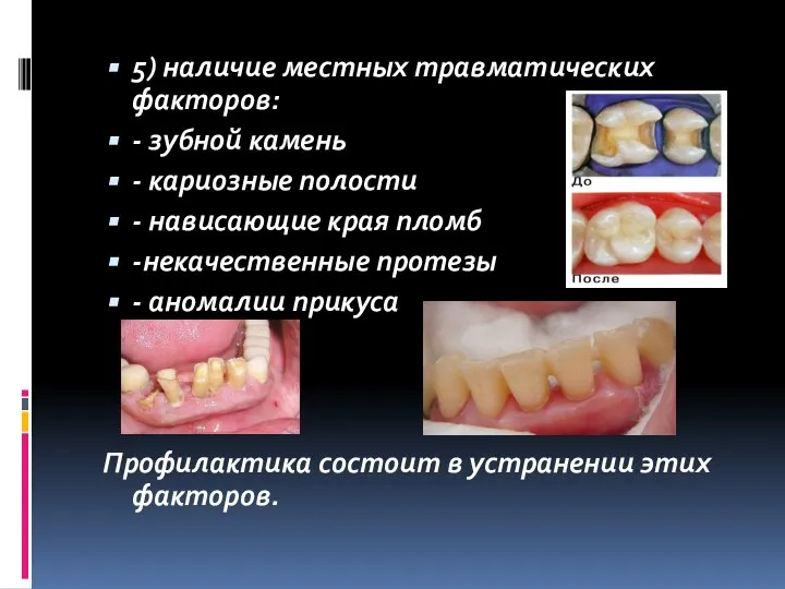 5) наличие местных травматических факторов: - зубной камень - кариозные полости -