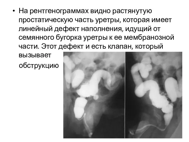 На рентгенограммах видно растянутую простатическую часть уретры, которая имеет линейный дефект наполнения,