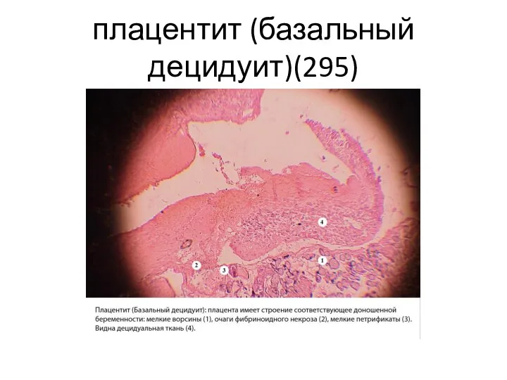 плацентит (базальный децидуит)(295)