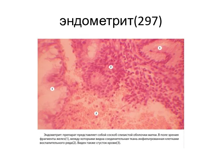 эндометрит(297)