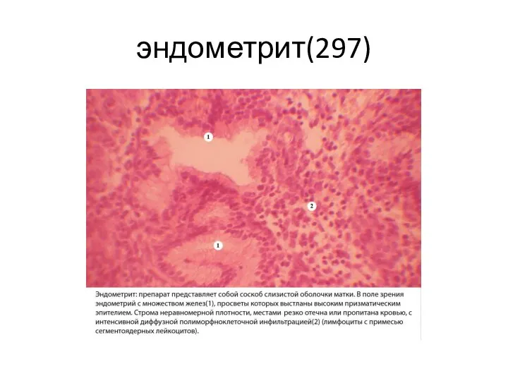 эндометрит(297)