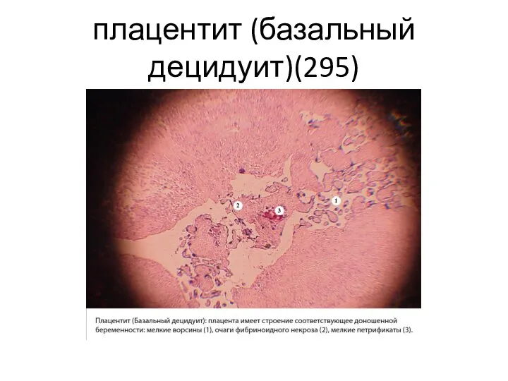 плацентит (базальный децидуит)(295)